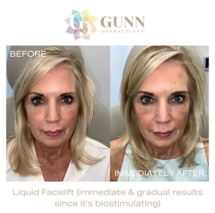 Did Anna Gunn have facelift? – Celebrity.fm – #1 Official Stars, Business & People Network, Wiki, Success story, Biography & Quotes